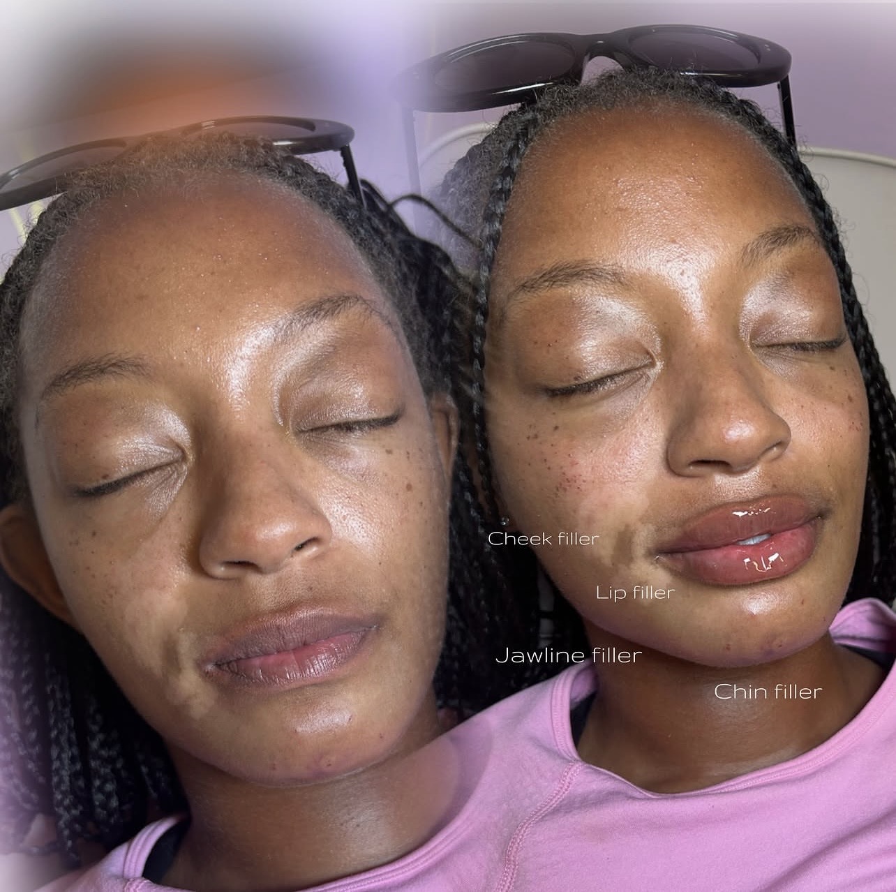 Facial balancing before and after, with the treated areas labelled on the image.